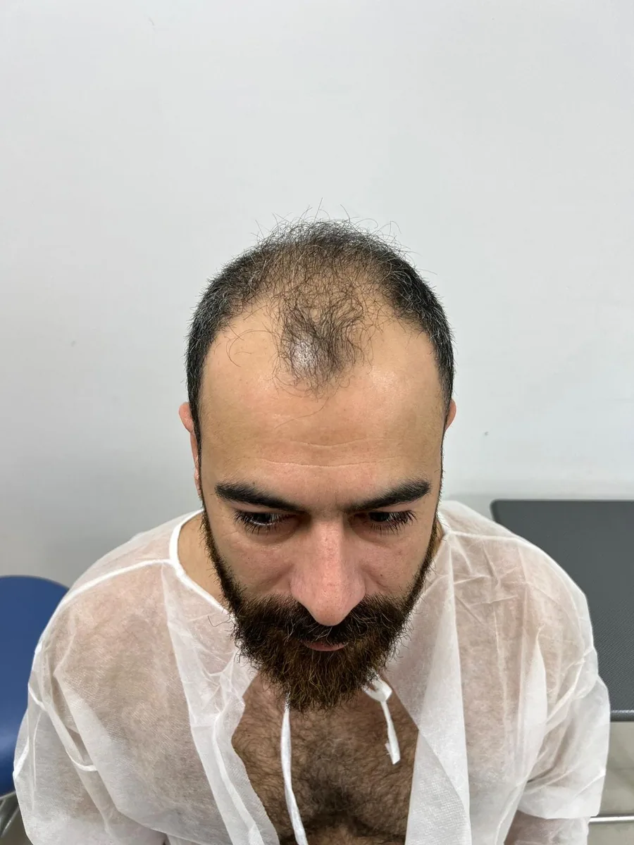 Before hair restoration