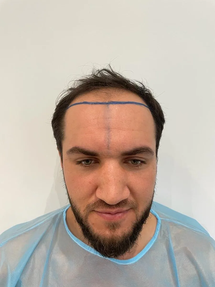 Before hair restoration
