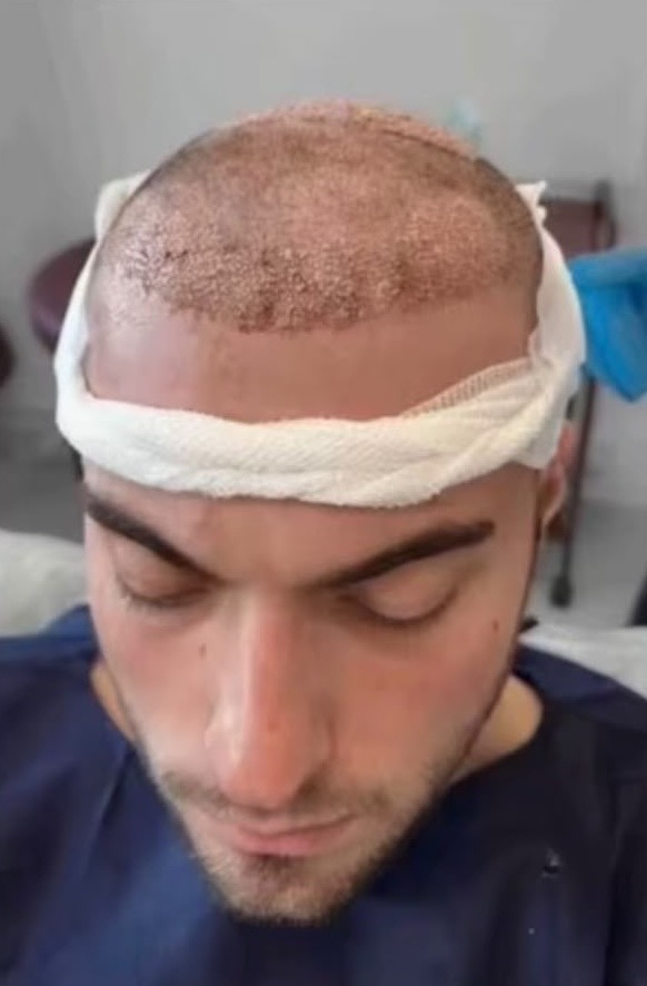 Before hair restoration
