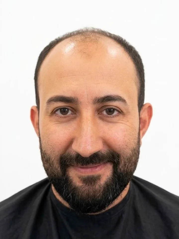 Before hair restoration