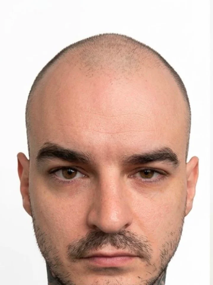 Before hair restoration
