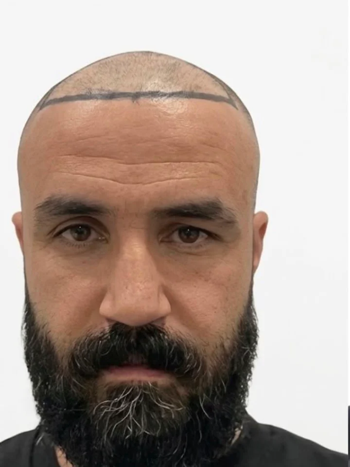 Before hair restoration