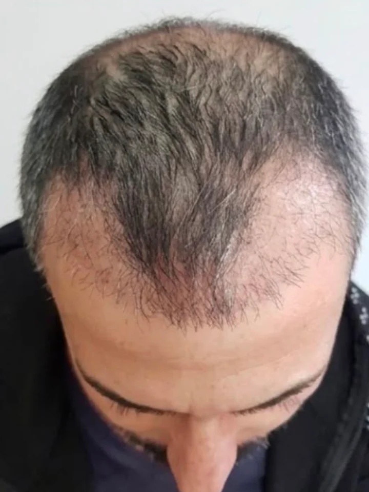 Before hair restoration