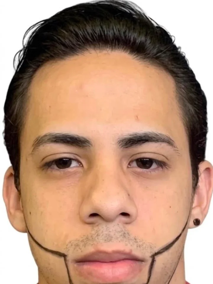 Before hair restoration
